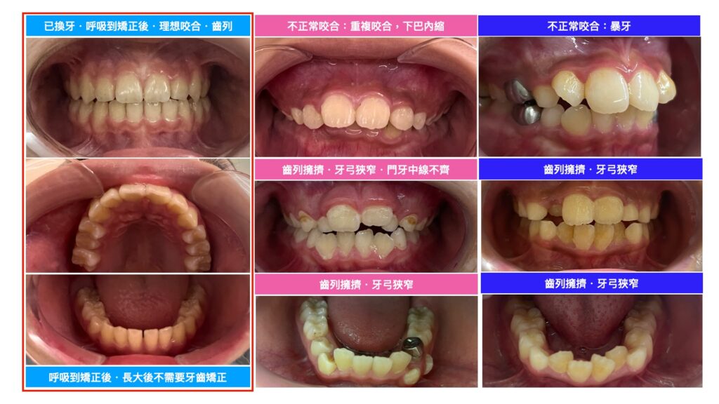 口呼吸 矯正案例